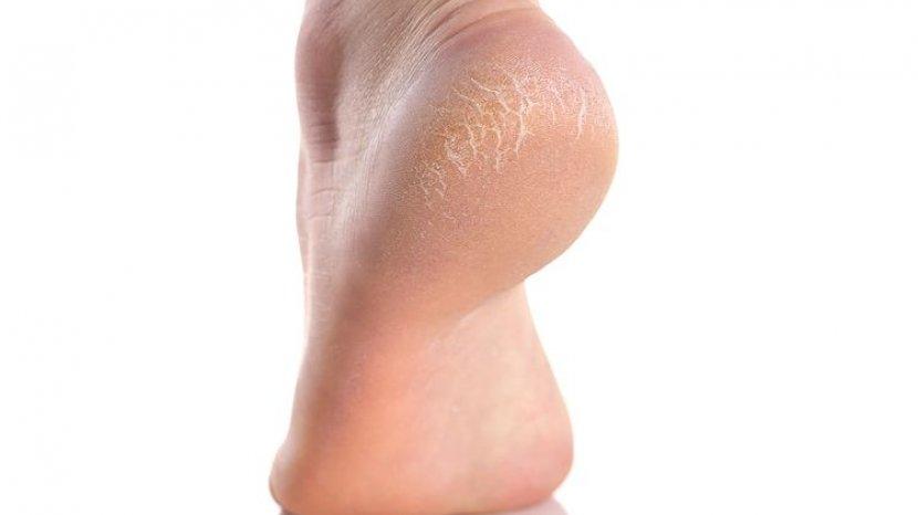 Perawatan Kaki gunakan Foot Cream, Cegah Kaki Pecah-pecah