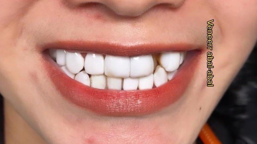veneer-gigi-abal-abal.jpg