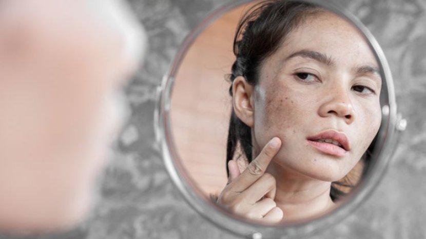 Sembuhkan Jerawat Secara Alami dengan 5 Manfaat Tea Tree Oil untuk Kulit