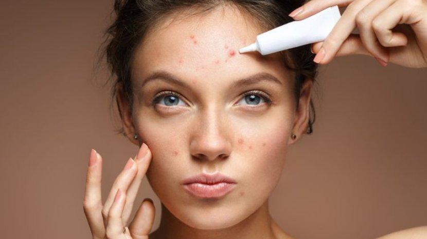 5 Rekomendasi Acne Spot Treatment Bawah Rp 100.000, Ampuh Kempiskan Jerawat Meradang