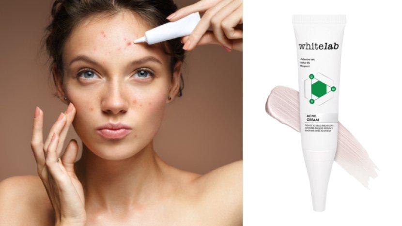 Review whitelab Acne Cream, Obat Totol Atasi Jerawat dalam 2 Hari