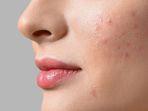 4 Rekomendasi Acne Spot Drying Lotion, Bubuk Sulfur yang Unik untuk Keringkan Jerawat