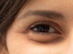 5 Cara Mengatasi Kantung Mata Paling Ampuh: Dimulai dari Skincare