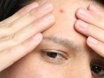 5 Rekomendasi Serum Penghilang Bekas Jerawat yang Manjur dan Mencerahkan