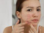 5 Rekomendasi Serum Salicylic Acid untuk Jerawat Membandel