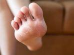 5 Tips Menyembuhkan Kutu Air Secara Alami, Bisa Pakai Garam hingga Bawang Putih
