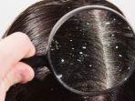 5 Tips dan Trik Paling Ampuh Menghilangkan Ketombe Memakai Bahan Alami