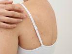 5 Bahan Alami yang Ampuh Mengatasi Jerawat di Badan yang Mengganggu