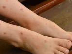 7 Bahan Alami Untuk Menghilangkan Bekas Luka Hitam di Kaki