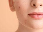 8 Hal Sepele yang Bikin Jerawat Makin Parah, Salah Satunya Terlalu Sering Cuci Muka