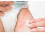 4 Rekomendasi Diaper Rash Cream Terbaik untuk Atasi Ruam Popok Bayi