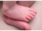 Tips Mengatasi Kulit Bayi yang Kering hingga Mengelupas saat Cuaca Dingin Seperti Sekarang