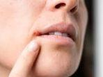 Obat Herpes Paling Ampuh, Manfaatkan 5 Bahan Alami Ini untuk Meredakan