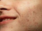 Tips Ampuh Atasi Flek Hitam Menurut Dermatologis, Salah Satunya Rajin Pakai Sunscreen