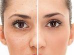 7 Bahan Alami Hilangkan Bopeng Bekas Jerawat di Wajah Tanpa Perlu ke Skin Care