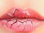 Bibir Pecah-pecah Bikin Lipstik Susah Nempel? Lakukan Perawatan Ini di Rumah
