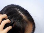 Bye-bye Rambut Berketombe dengan 5 Bahan Herbal Ini, Kulit Kepala Lebih Sehat