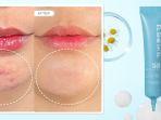 7 Rekomendasi Obat Totol Jerawat atau Acne Spot Paling Ampuh yang Aman dan BPOM