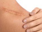 7 Cara Mengatasi Bekas Luka di Kulit, Mulai dengan Bahan Alami hingga Treatment Dokter