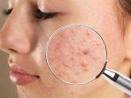 Bisa Memperparah Kondisi Jerawat, Acne Fighter Wajib Hidari 8 Kandungan Skincare Ini