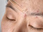 7 Rekomendasi Serum Jerawat Paling Ampuh, Cocok Jadi Pilihan Acne Fighter