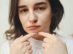 8 Cara Mengatasi Jerawat Hormonal, Biasanya Muncul Jelang Menstruasi atau Saat Hamil