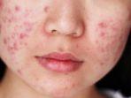 Simak 6 Kondisi yang Dapat Memicu Timbulnya Jerawat Hormonal