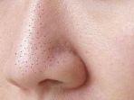 8 Penyebab Kulit Wajah Muncul Komedo, Mulai dari Pengaruh Hormon hingga Salah Pilih Skincare
