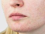 9 Kandungan Skincare Cocok untuk Kulit Kering agar Kembali Lembap