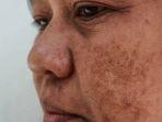 Cara Menghilangkan Melasma pada Wajah, Bisa Gunakan Produk Kecantikan yang Mudah Ditemukan