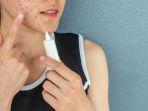 5 Rekomendasi Acne Spot Terbaik, Dijamin Ampuh Hempas Jerawat tanpa Iritasi