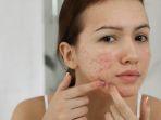 5 Rangkaian Skincare azarine untuk Hilangkan Jerawat di Wajah