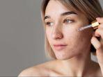 5 Rekomendasi Serum Terbaik untuk Para Acne Fighter