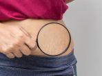 Stretch Mark Buatmu Kurang Percaya Diri? Atasi dengan 5 Rekomendasi Produk Ini