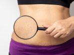 Muncul Stretch Mark Pasca Melahirkan? Atasi dengan 5 Rekomendasi Krim Ini