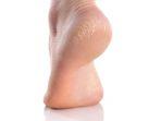 Perawatan Kaki gunakan Foot Cream, Cegah Kaki Pecah-pecah