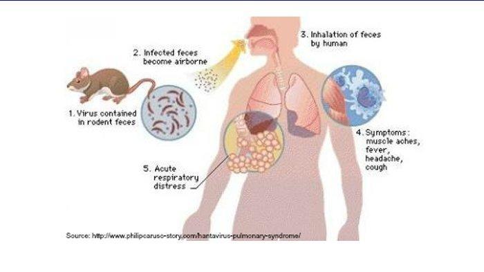 HANTAVIRUS - Ilustrasi orang yang terjangkit hantavirus. Hantavirus kembali menjadi perhatian publik setelah dilaporkan merenggut korban jiwa di kapal pesiar MV Hondius yang berlayar dari Argentina beberapa waktu lalu.