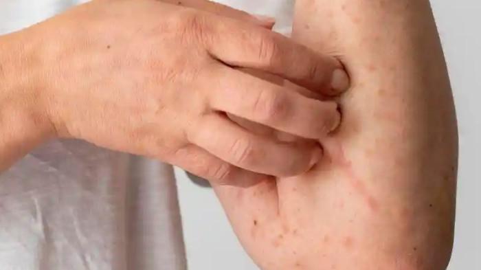 ILUSTRASI - Ilustrasi sakit campak. Data dari Kementerian Kesehatan Republik Indonesia mencatat hingga minggu ke-8 tahun 2026 terdapat 10.453 suspek campak, dengan 8.372 kasus terkonfirmasi serta enam kasus kematian. Kabupaten Sukoharjo belum terpapr