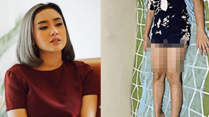 Cita Citata Bagikan Cerita Sembuhkan Sakit Autoimun yang Ia Derita, Jalani Pengobatan Alternatif