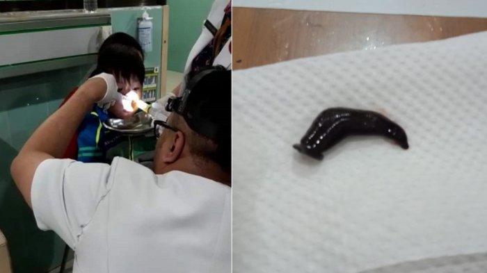 Viral Kisah Bocah 4,5 Tahun di Banjarsari Solo Mimisan Setengah Bulan, Ternyata Ada Lintah di Hidung