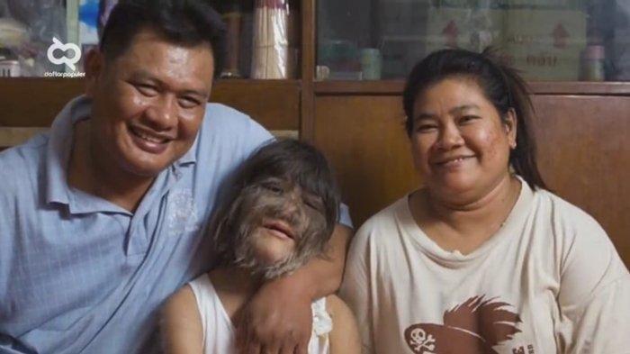 Ingat Gadis yang Pernah Viral karena Wajah Penuh Bulu? Kini Ia Bahagia, Sudah Nikah dan Punya Anak