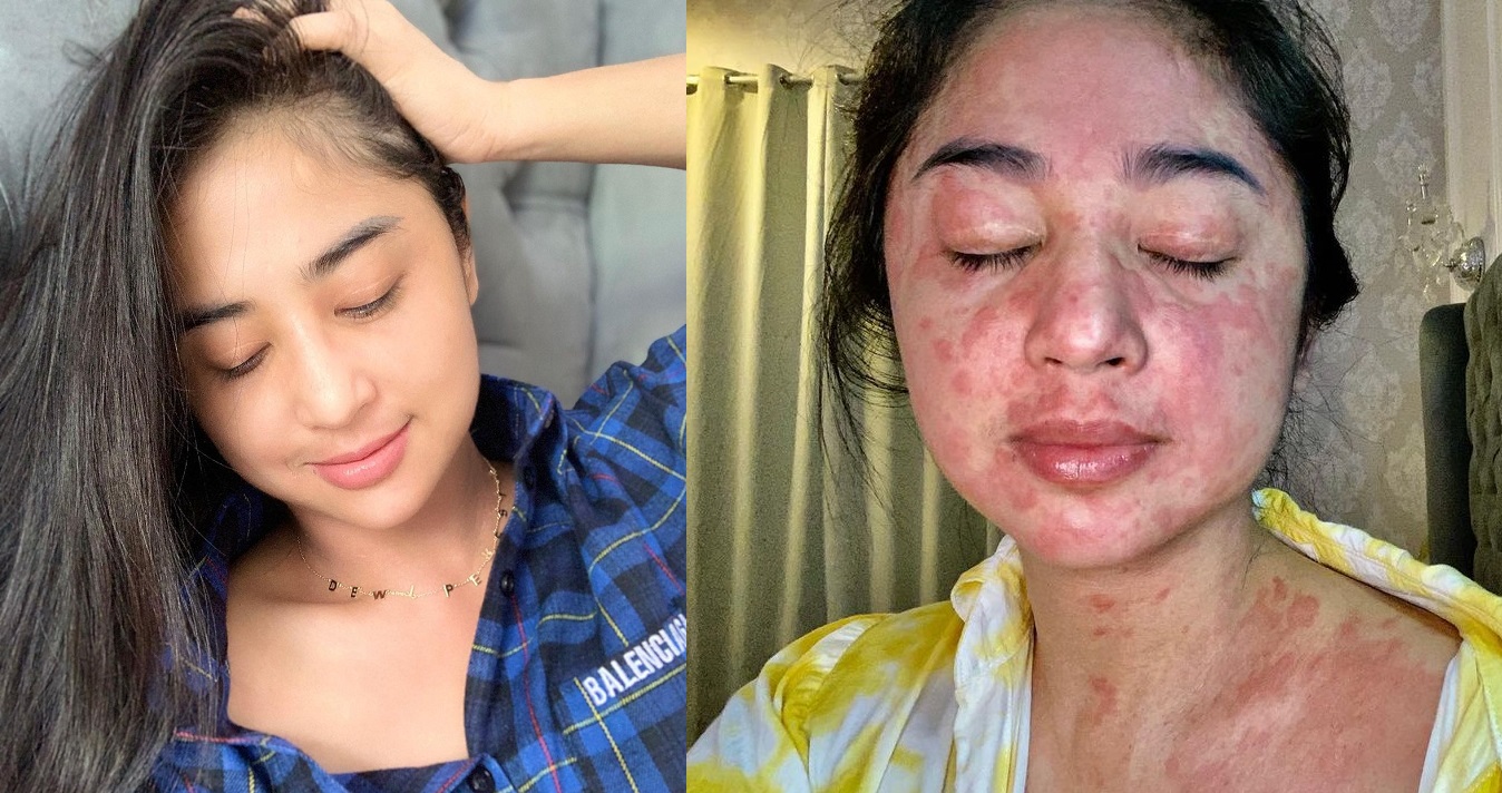 Dewi Perssik Umumkan Dirinya Kini Negatif Covid-19 setelah Sempat 2 Kali Positif hingga Harus Rehat