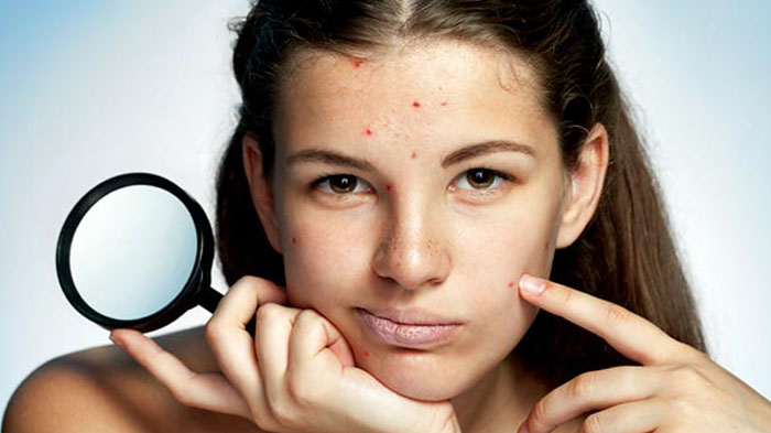 ilustrasi-wajah-berjerawat.jpg