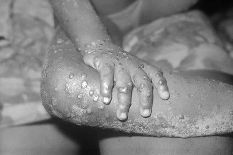 inilah-tanda-anak-terkena-gejala-cacar-monyet-monkeypox.jpg