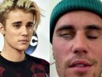 Justin-Bieber-idap-ramsay-hunt-syndrome.jpg