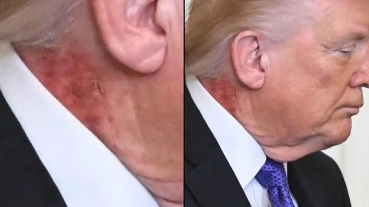 Bercak merah di leher Presiden Amerika Serikat (AS) Donald Trump menarik perhatian para fotografer.