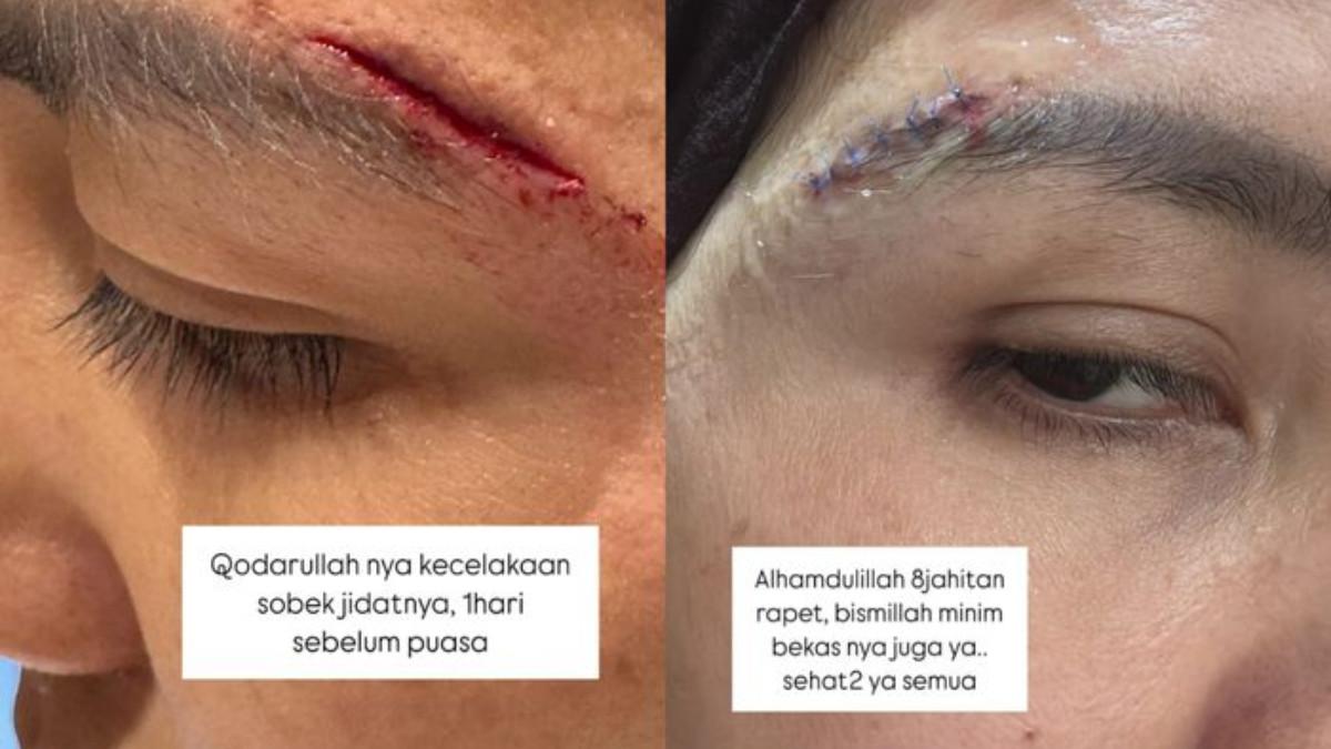 Tya Ariestya mengalami kecelakaan hingga bagian dahinya robek satu hari sebelum Ramadan.