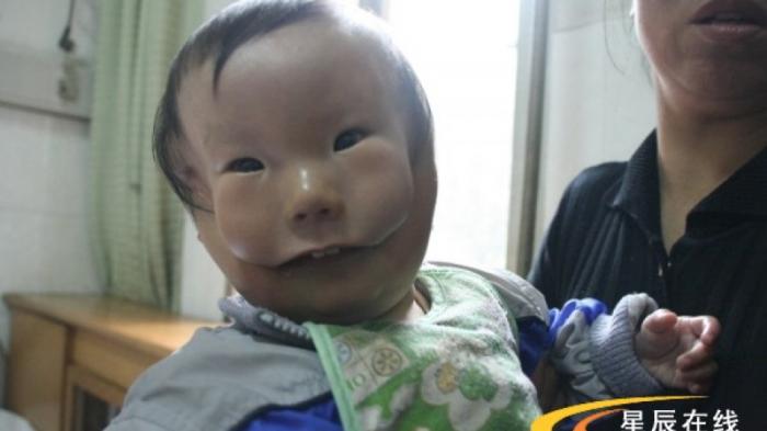 Bayi Ini Terlahir dengan Wajah Seperti Bertopeng, Inilah Penyebab Menurut Analisa Dokter