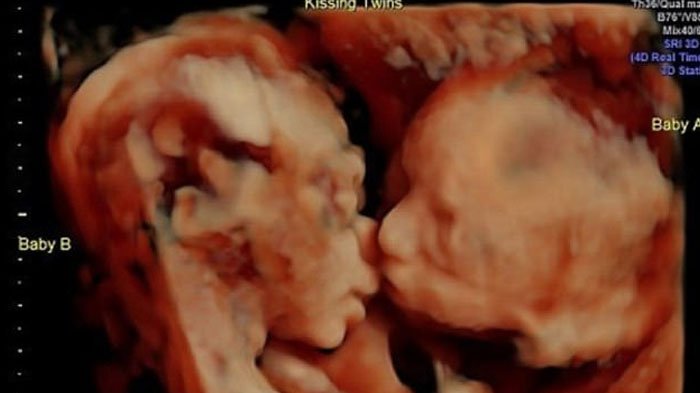 Viral! Bayi Kembar Ini Terlihat Berciuman di Dalam Rahim, Bikin Sang Ibu Terharu