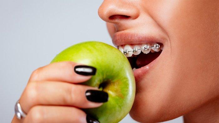 Dari Permen Karet hingga Es Batu, Ini 5 Makanan yang Wajib Dihindari Saat Memakai Behel Gigi